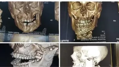 نجاح الفريق الطبي بدكرنس العام في إنقاذ طفل من تهشم كامل بالوجه