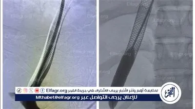فريق طبي بجامعة أسيوط ينقذ حياة فتاة تعاني من فشل كبدي باستخدام الأشعة التدخلية