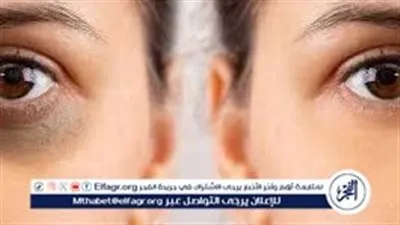 5 وصفات طبيعية للتخلص من الهالات السوداء وإطلالة نضرة وحيوية