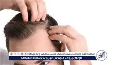 وصفات طبيعية لعلاج قشرة الرأس والتخلص من الحكة والإحراج