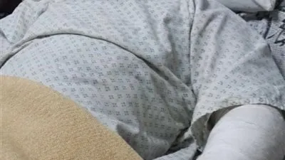 إصابة طفل بحروق بالغة إثر سقوطه على زيت مغلي بعد اصطدامه بدراجة نارية ببنها