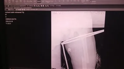 صحة الدقهلية: إنقاذ شاب من كسر مضاعف بالفخذ بعد تدخل جراحي دقيق بمستشفى طلخا المركزي