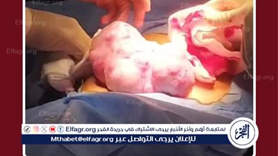نجاح جراحة دقيقة لاستئصال ورم خبيث بوزن 2 كجم لطفلة بمستشفي طنطا الجامعي
