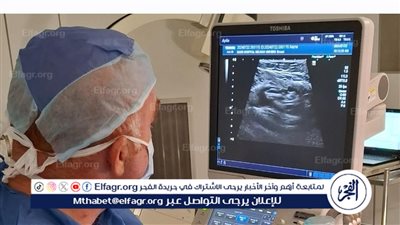 لأول مرة بمستشفى بدر الجامعي: إنهاء معاناة نزيف مزمن لثلاث سنوات بتقنية القسطرة التداخلية 
