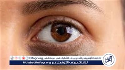 «لو تحت عينيكي أسود».. 8 أسباب طبية وراء الهالات السوداء وكيفية علاجها بذكاء