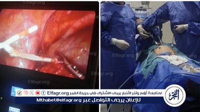 تدخل عاجل بمنظار جراحي بمستشفى بلقاس لإنقاذ مريضة من مضاعفات اختراق لولب لجدار الرحم والقولون