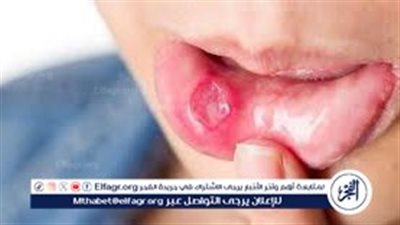 بقع بيضاء وألم أثناء الأكل؟.. 7 خطوات بسيطة تساعدك على التخلص من فطريات الفم واللسان بسرعة